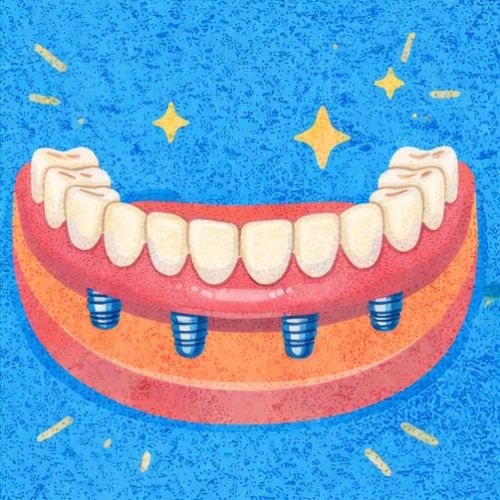 Полная имплантация методом All-on-4