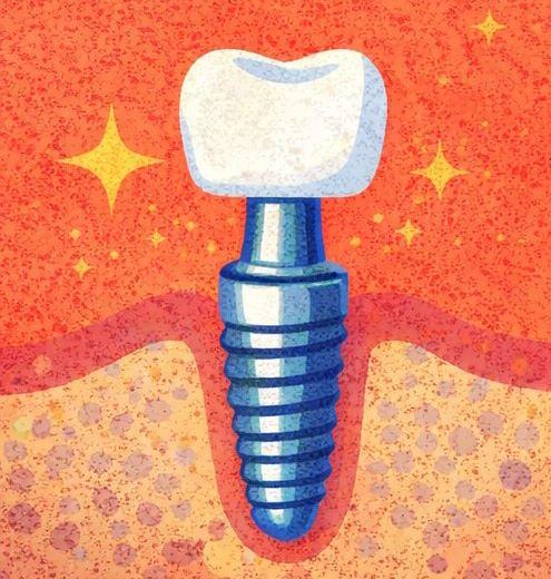 Имплантация