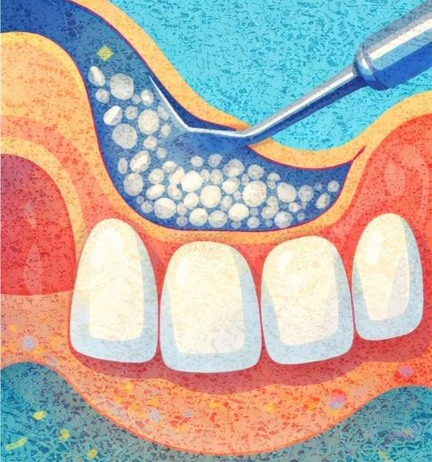 Синус-лифтинг