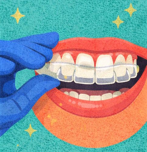 Установка элайнеров