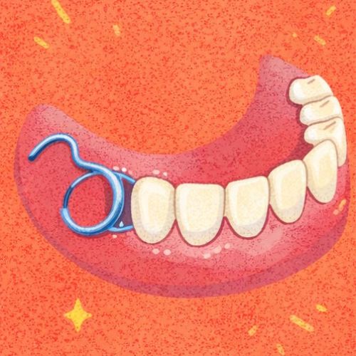 Протезирование 2 и 3 зубов подряд