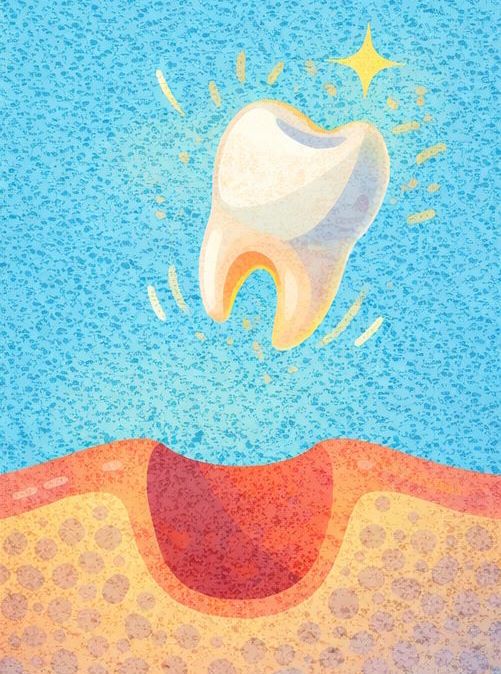 Удаление молочных зубов