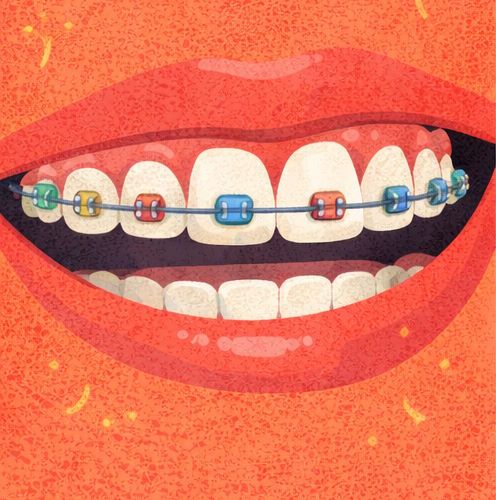 Установка брекетов